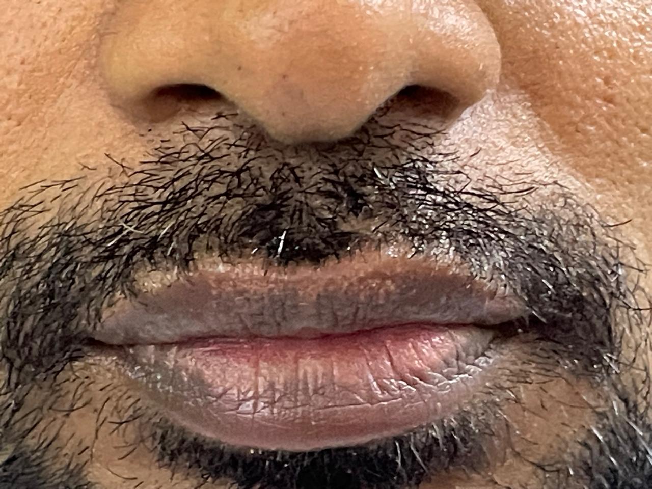 Before - Pigmentation